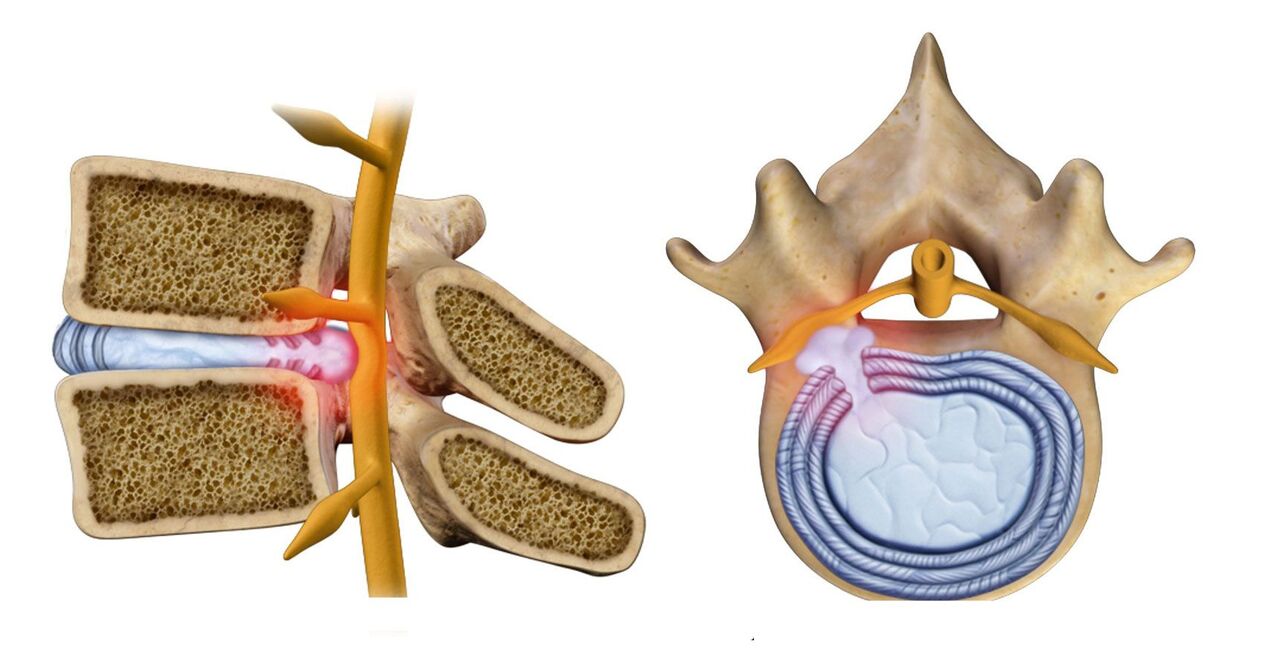 vertebral hernia in thoracic osteochondrosis