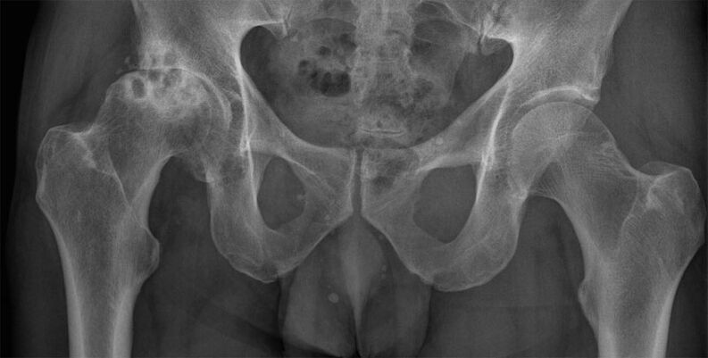 Deforming osteoarthritis of the hip joint on x-rays