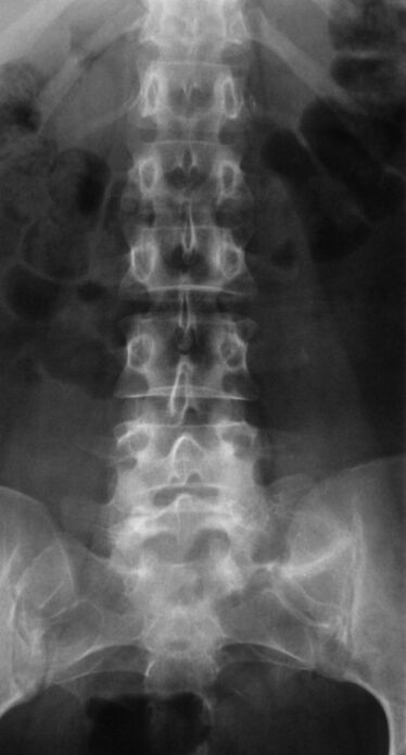 To diagnose lumbar osteochondrosis, an x-ray is taken