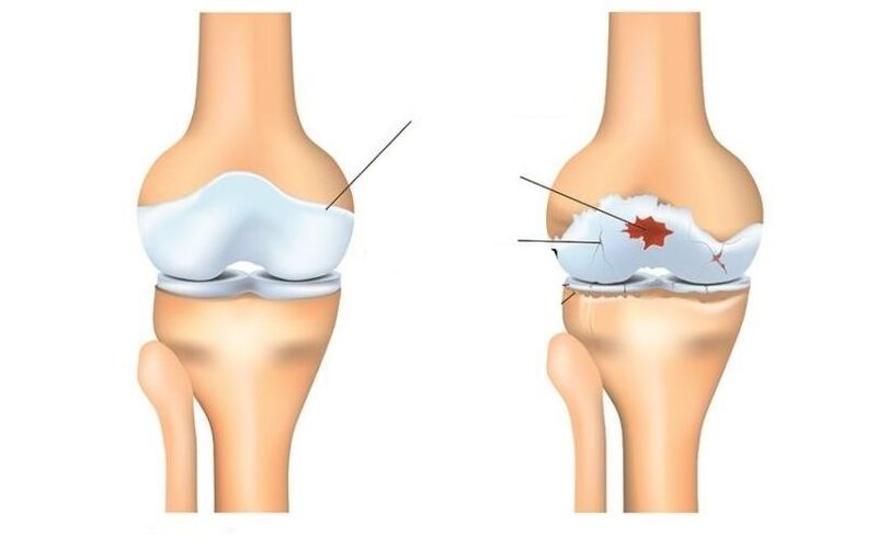 Healthy and patient with arthritis joints