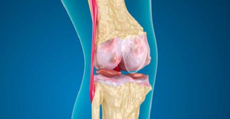 osteoarthritis of joint knee disease, which causes cartilage destruction in joints