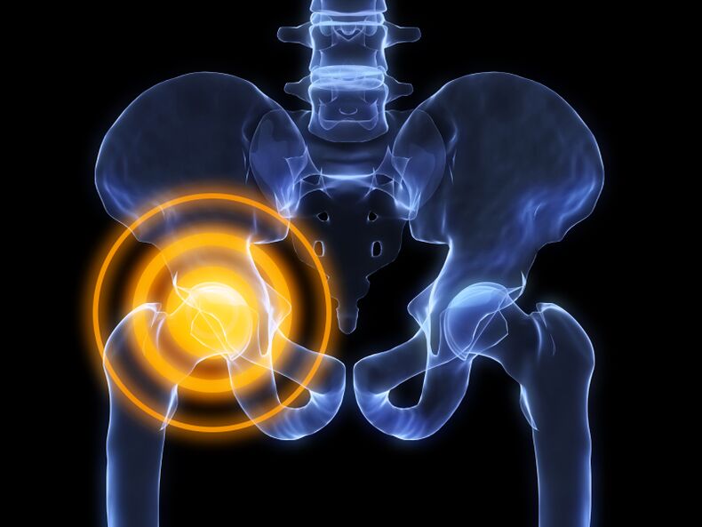 osteoarthritis of the hip joint