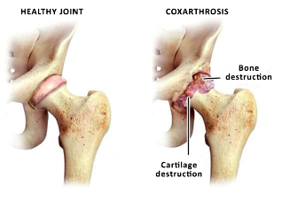 comparison of a healthy joint and zustavas hip